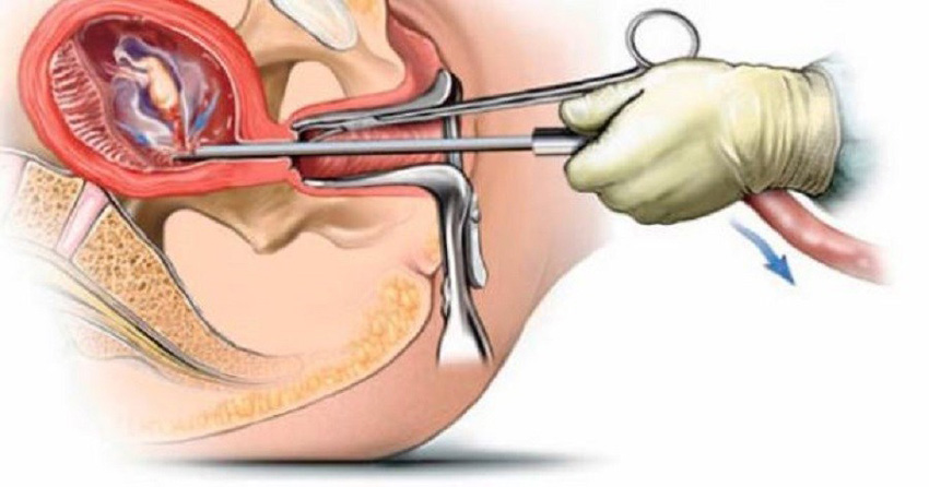 दक्ष जनशक्ति अभावले सुरक्षित गर्भपतन सेवा बन्द